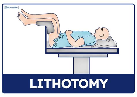 截刀臥位姿勢|截石位 lithotomy position